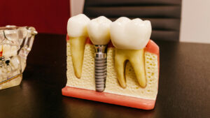 Dental implants with screw