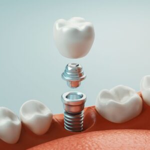 Cosmetic Dentistry 5 dental implants