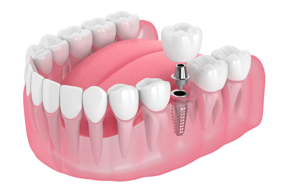 dental implant