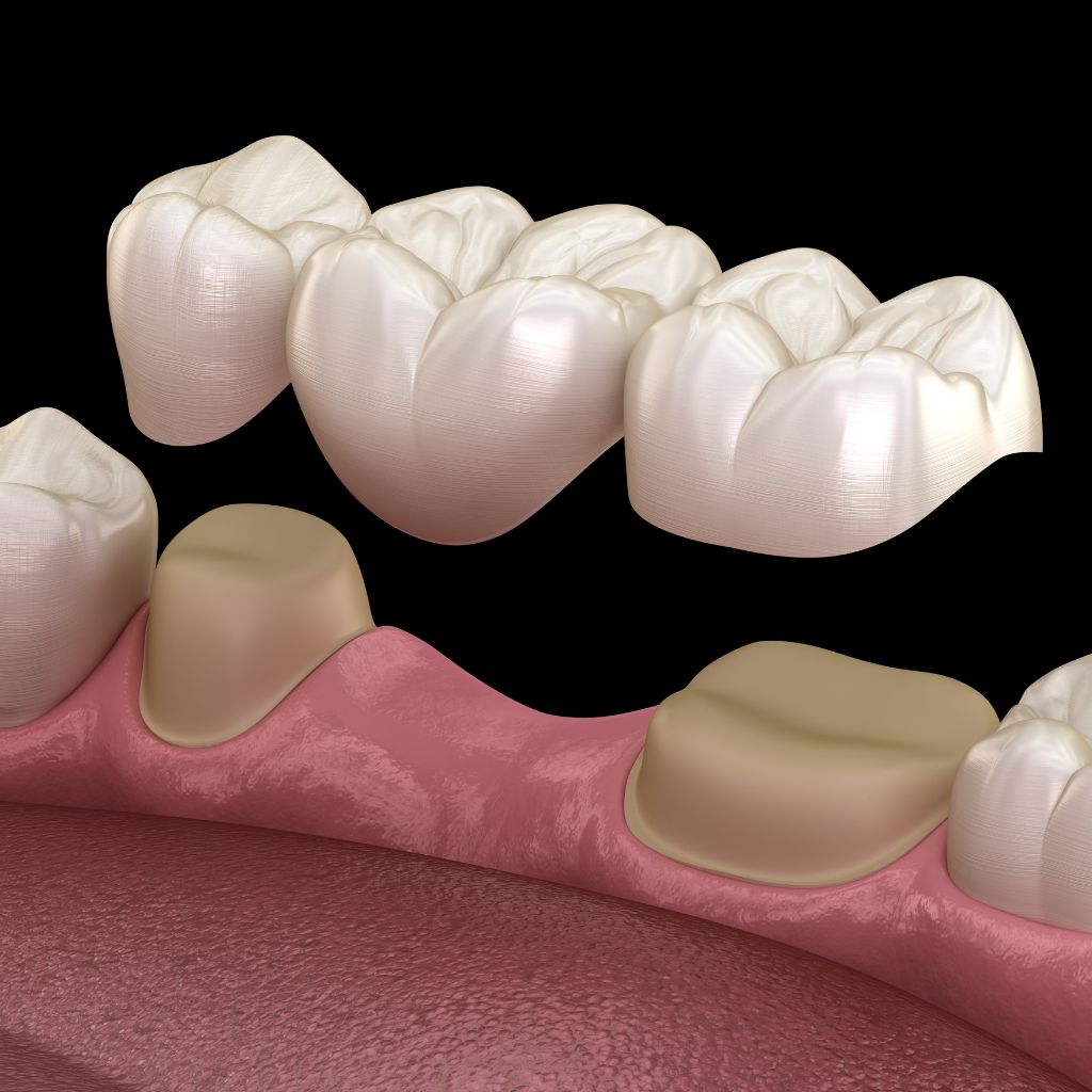 Bridges 1 showing a dental bridge