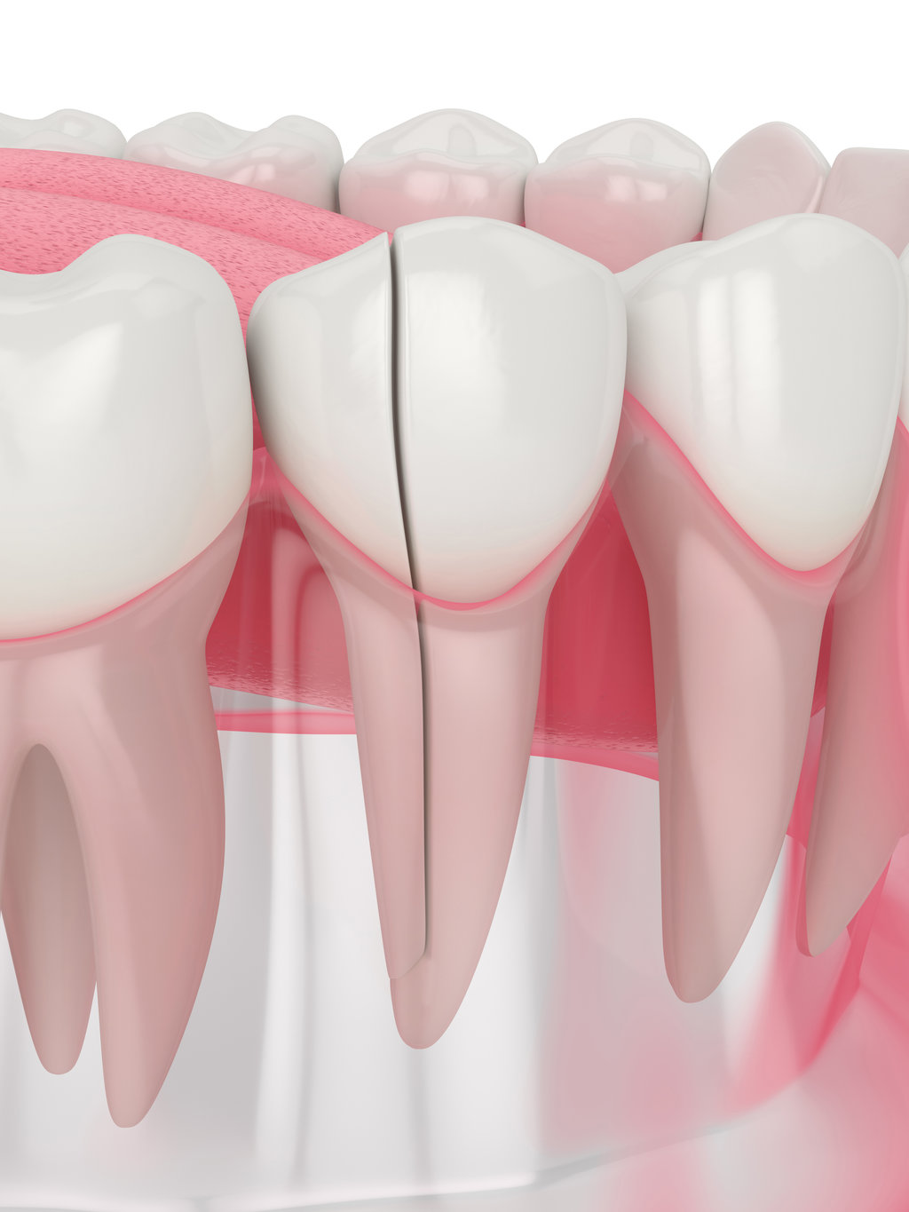 Cracked Tooth Treatments in Allentown, PA 1 3d render of jaw with split tooth over white background. Types of broken teeth concept.